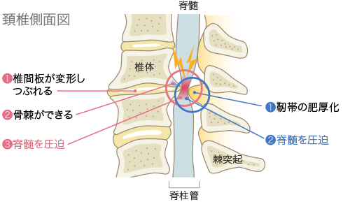 首の骨棘はどのように治療されますか?